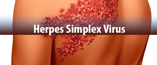 Herpes-Simplex-Virus und natürliche Behandlungsmethoden
