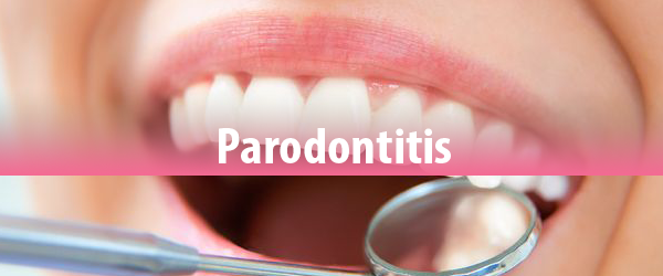 Parodontitis - natürliche Vorbeugung und Behandlung